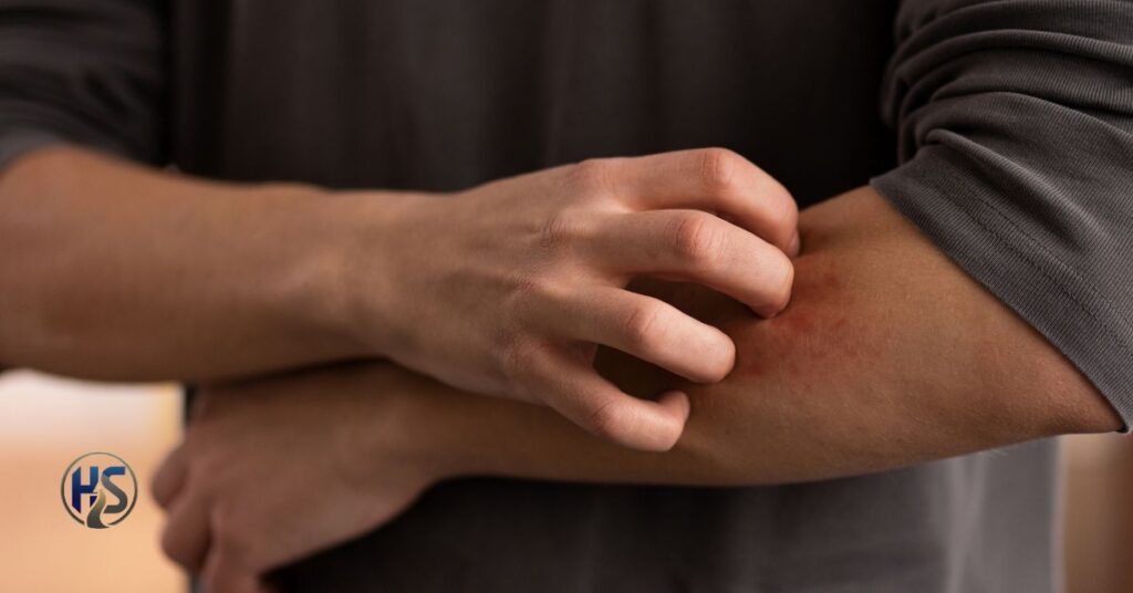 Poison Ivy Rash Stages