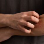 Poison Ivy Rash Stages