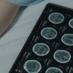 Brain Inflammation