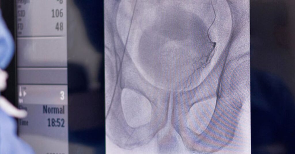 Normal Size of Prostate