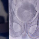 Normal Size of Prostate