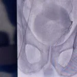 Normal Size of Prostate